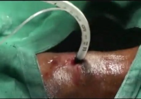 surgical-airway-458x320