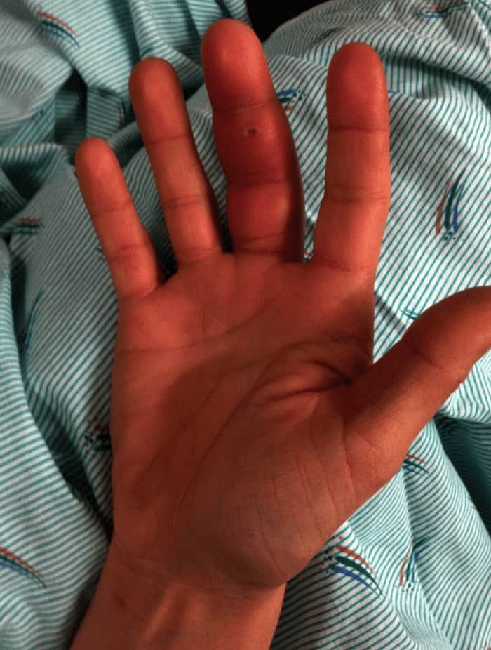 featured-flexor-tenosynovitis