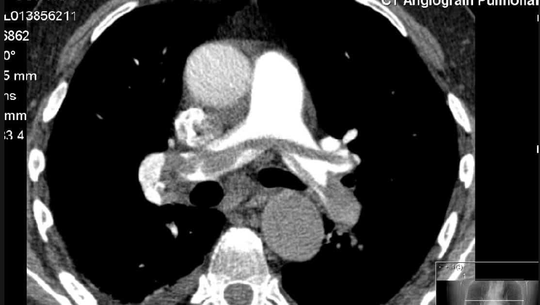 featured-pulmonary-embolism