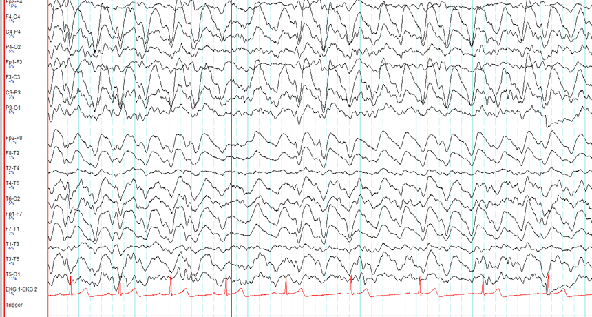 Phenytoin and Levetiracetam: EcLIPSE and ConSEPT