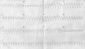pacemaker tachycardia