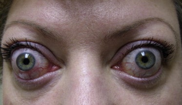 Saudi Journal of Ophthalmology
Volume 25, Issue 1, January–March 2011, Pages 3-13