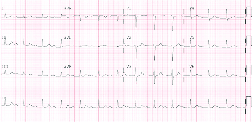 Electrocardiogram-showing-first-degree-atrioventricular-block-with-PR-interval-of-320-ms